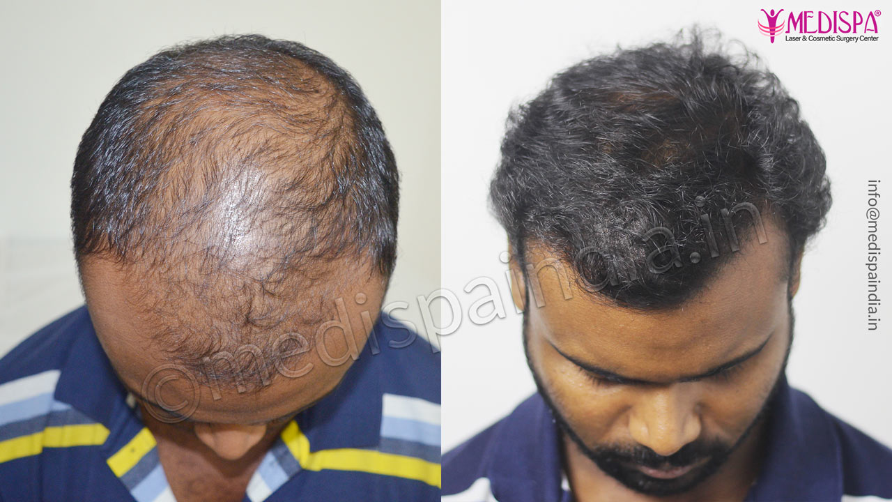 hair transplant cost in india