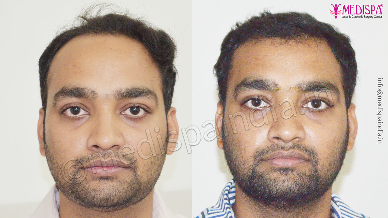 hair transplant in kolkata india