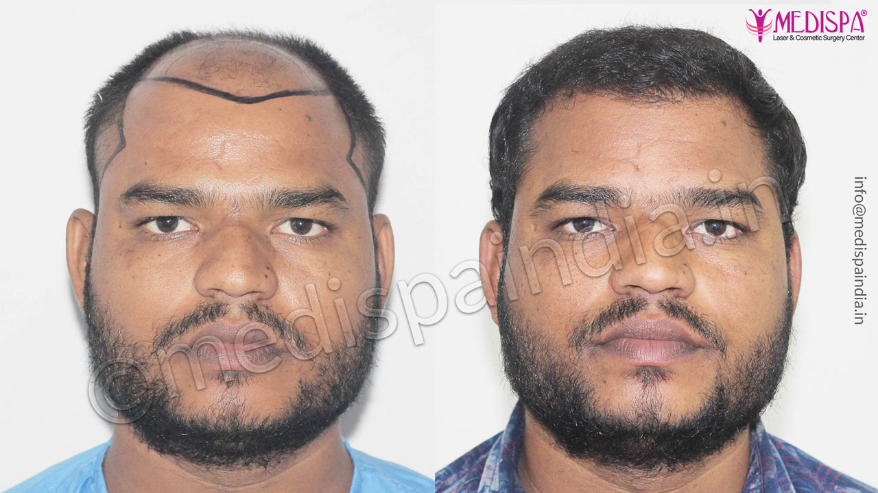 hair transplant cost in india