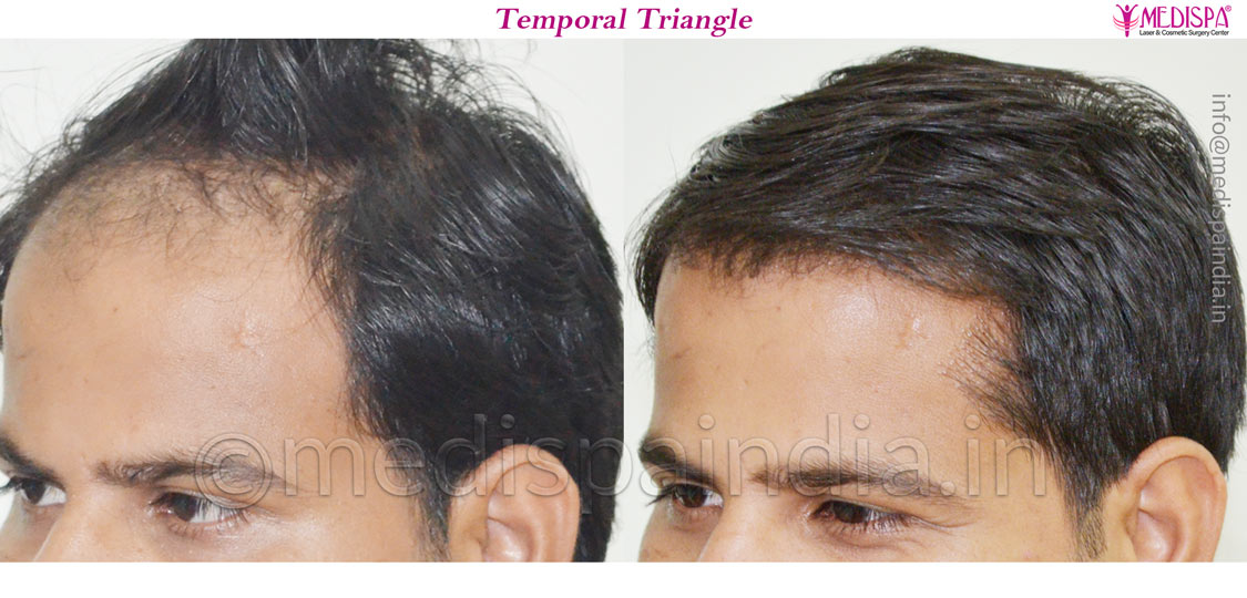hair transplant in noida