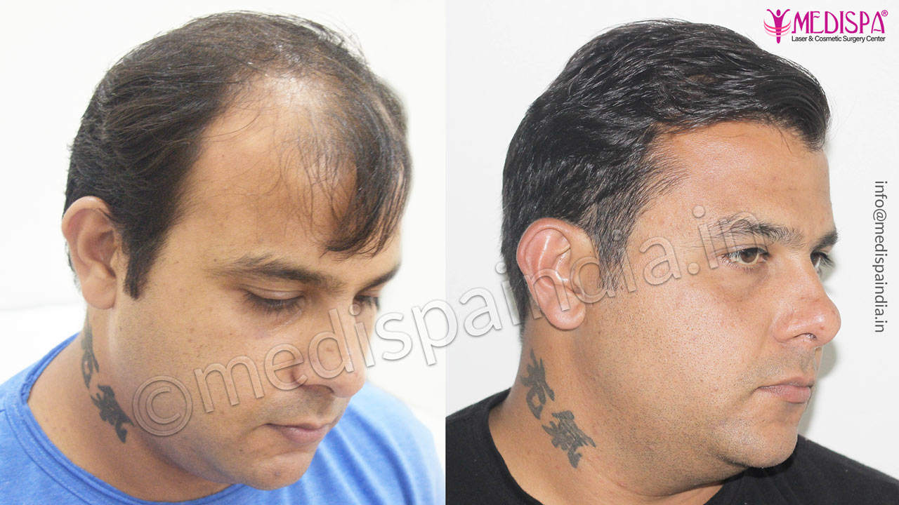 hair transplant in odhisha