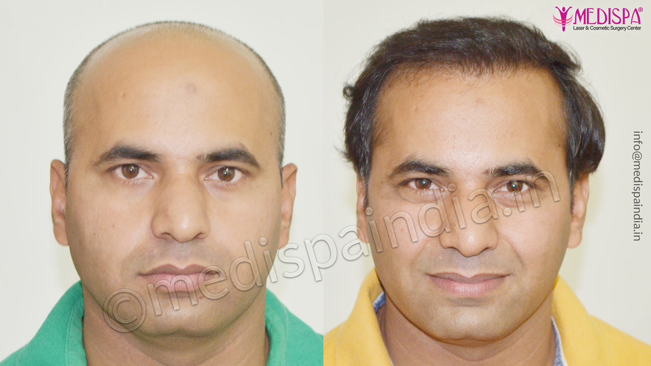 hair transplant in rajasthan