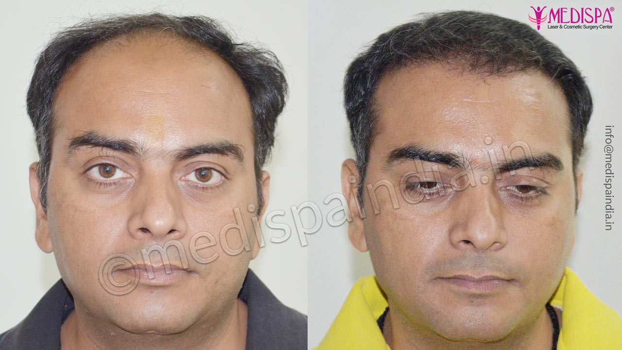 hair transplant in surat gujarat