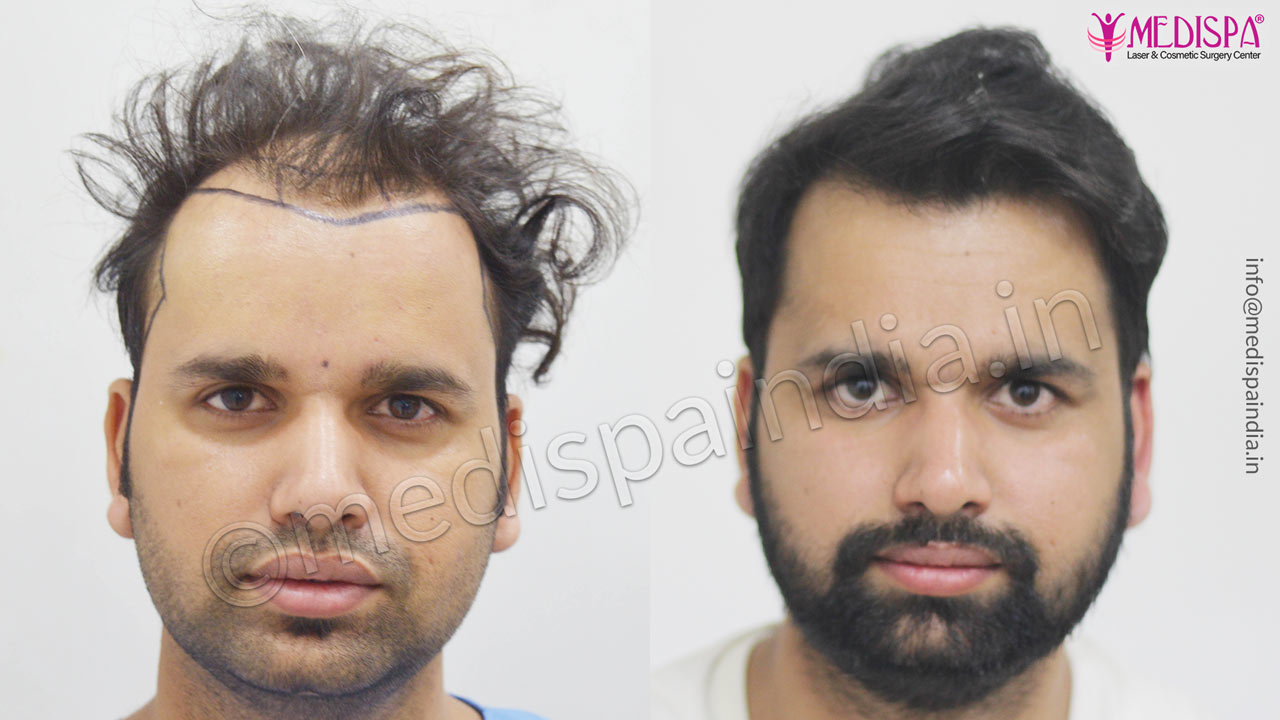 hair transplant in sydney australia