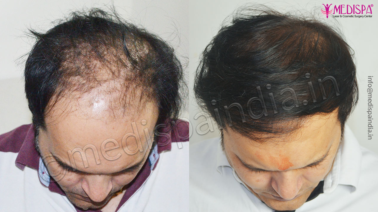 hair transplant in toronto