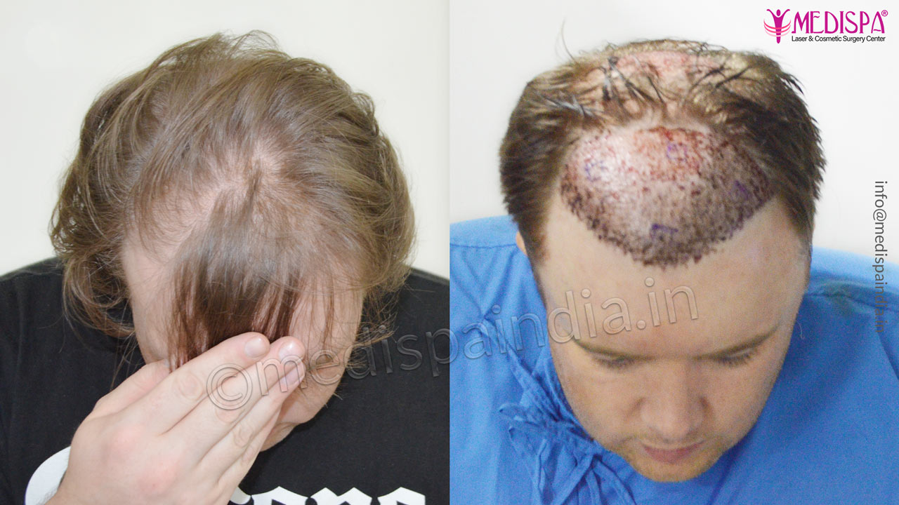 hair transplant in usa