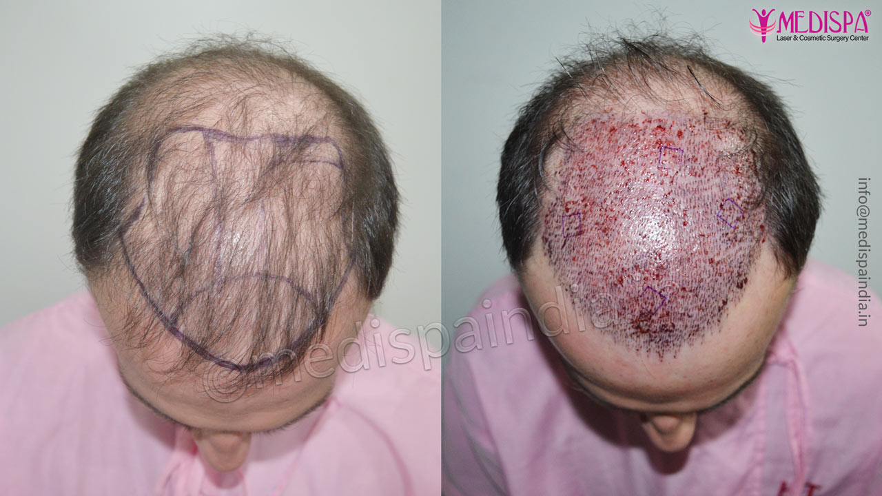 hair transplant ireland before after