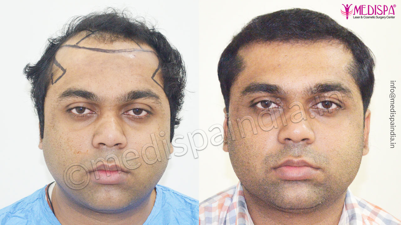 hair transplant cost in india