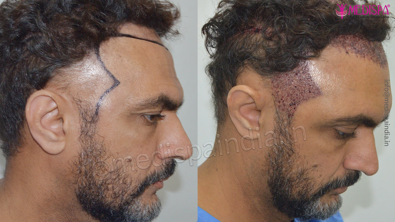 hair transplant malaysia results