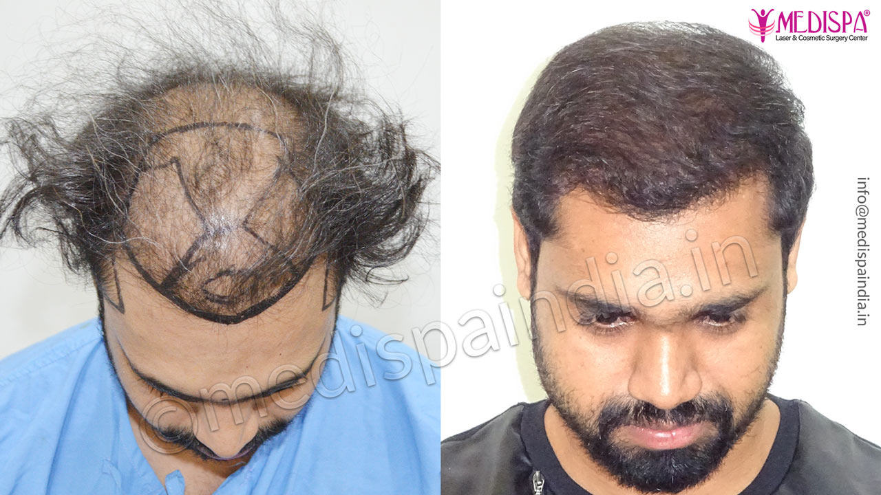 hair transplant mumbai cost