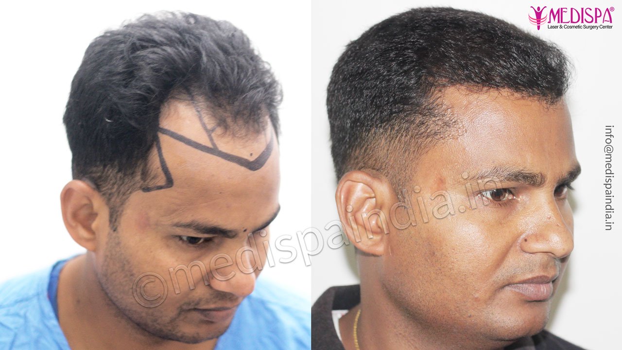 hair transplant rajathan before after