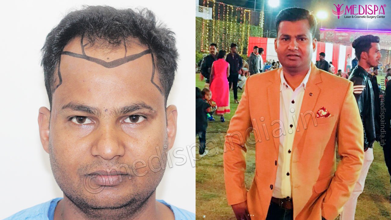 hair transplant rajathan results 12 months
