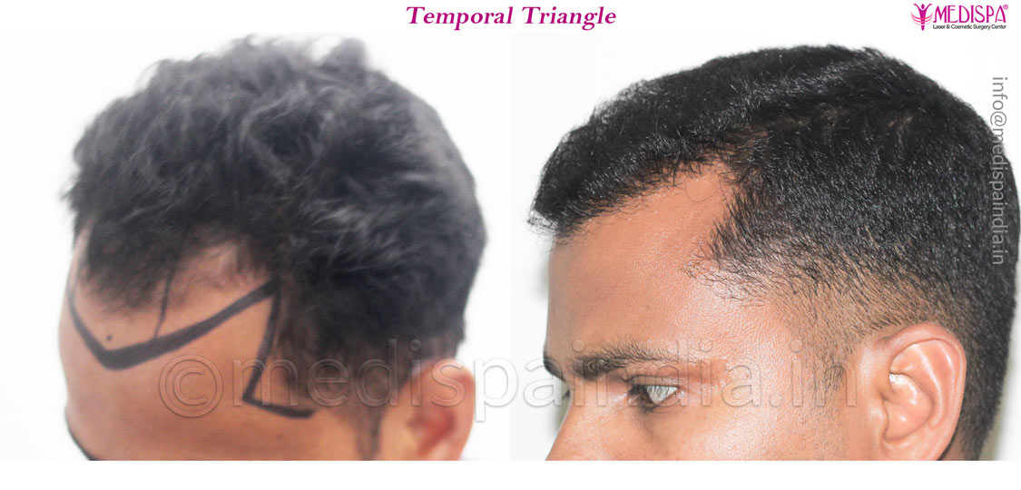 hair transplant rajathan results 8 months