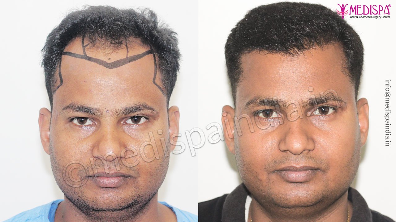 hair transplant Hyderabad results