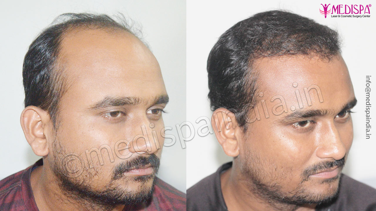 hair transplant results after 1 year