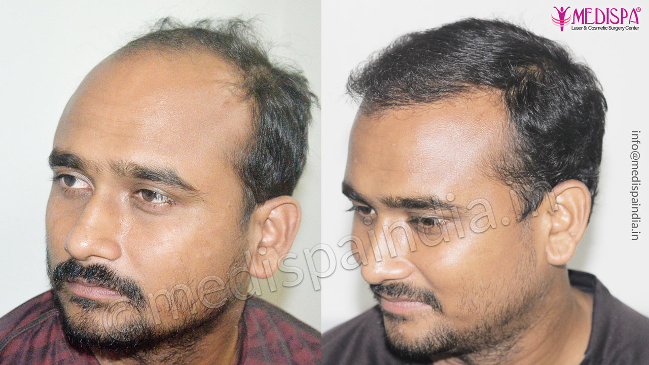 hair transplant results after 10-months