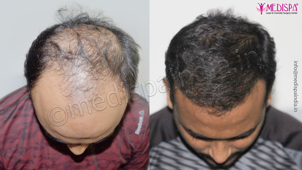 hair transplant results after 12-months