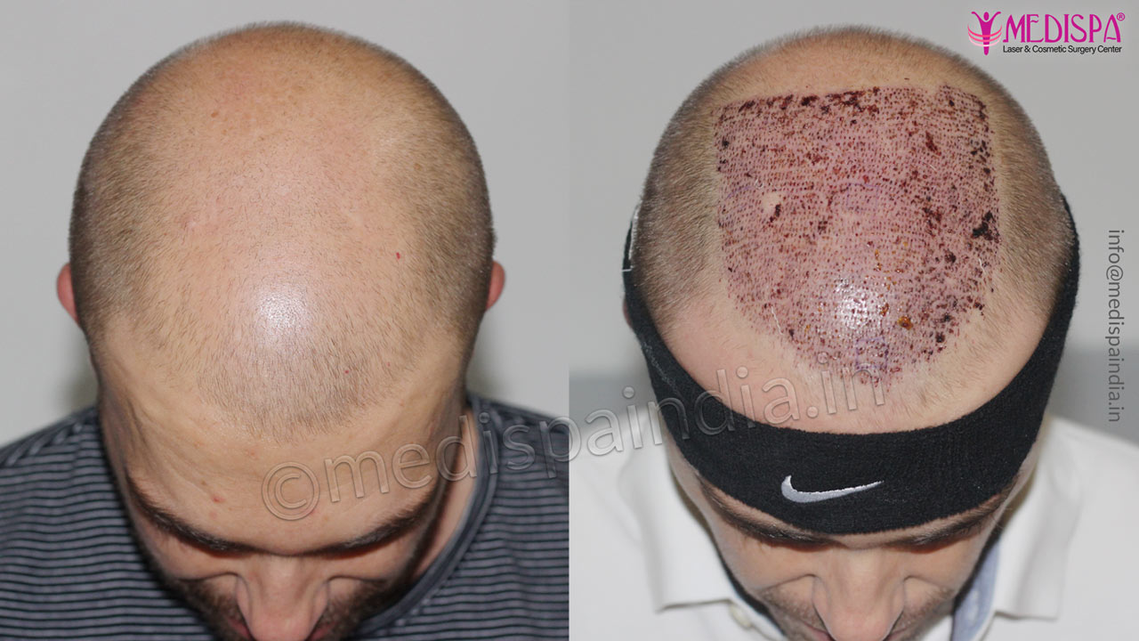 hair transplant results australian