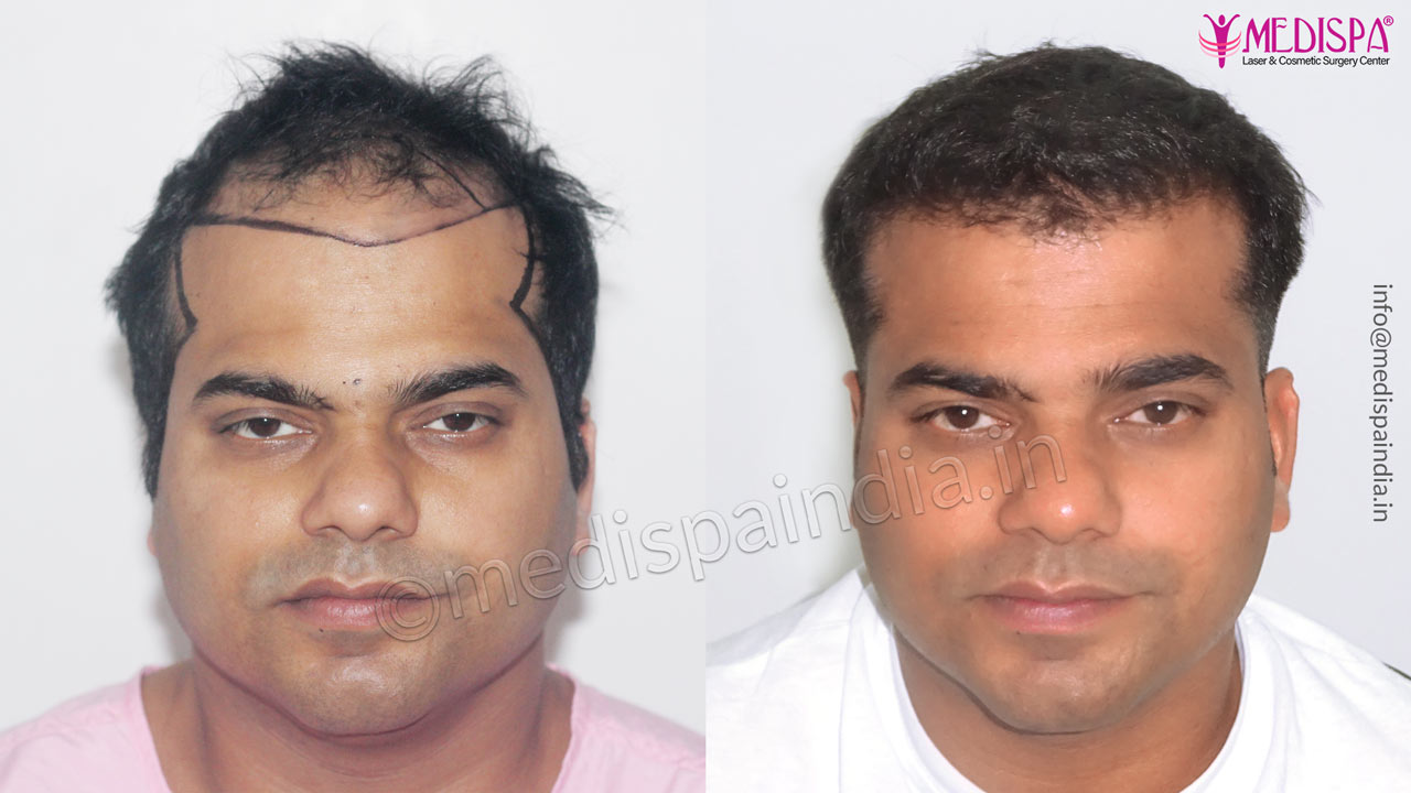 hair transplant cost in india