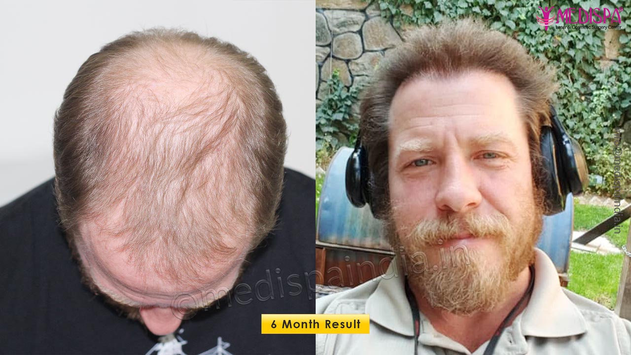 hair transplant results usa