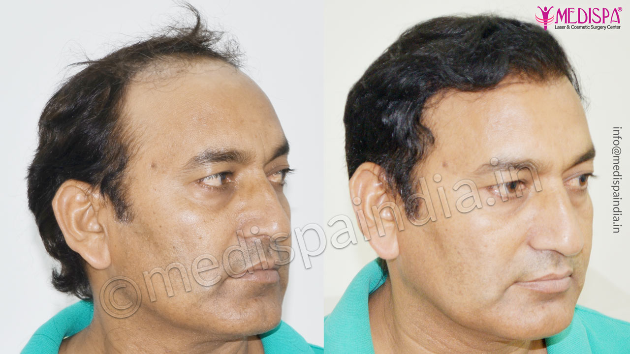 hair transplant south delhi