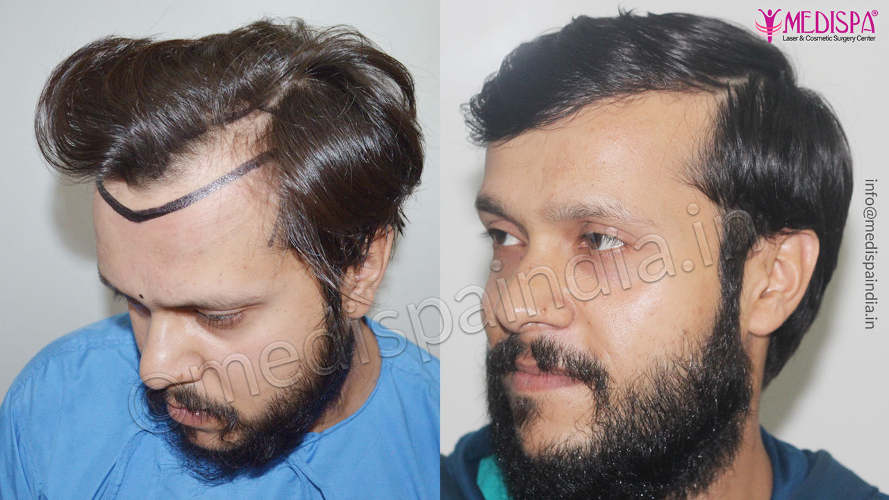 hair transplant surgeons in chandigarh india