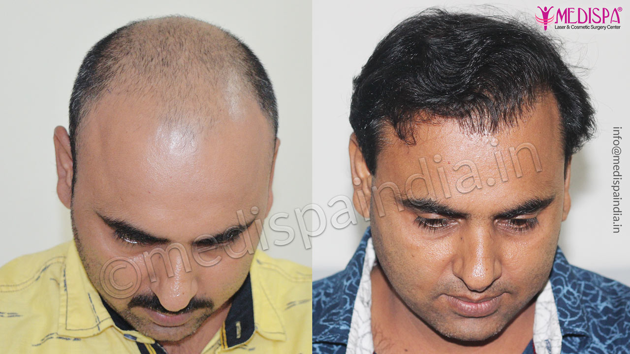 hair transplant surgeons in faridabad