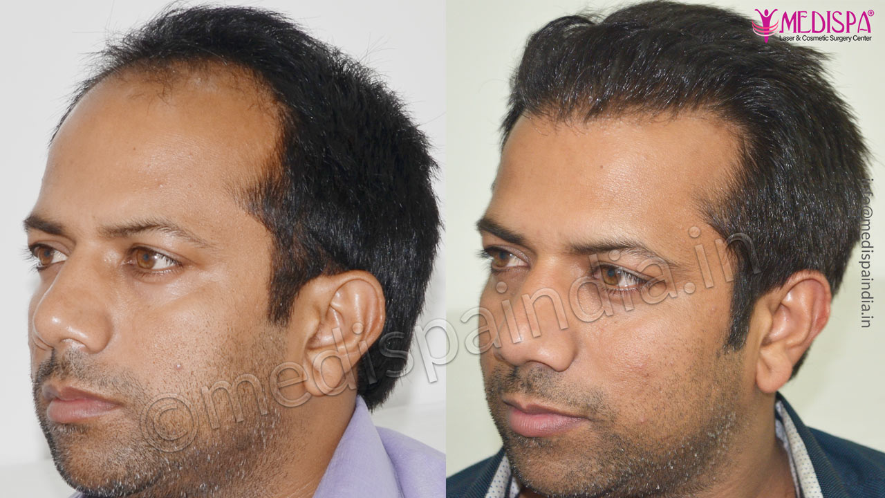 hair transplant surgeons in gurugram
