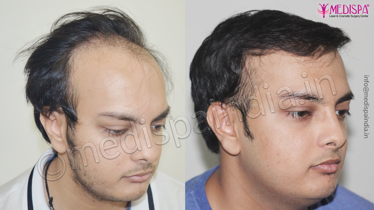 hair transplant surgeons in jodhpur