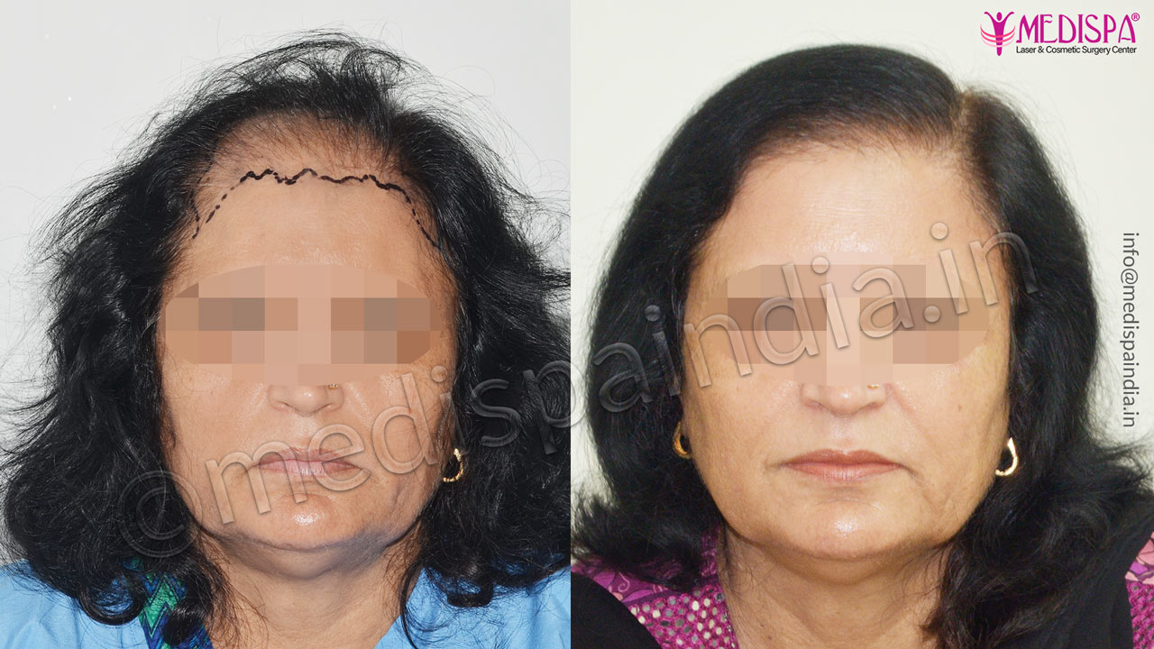 hair transplant surgeons in south delhi new-delhi
