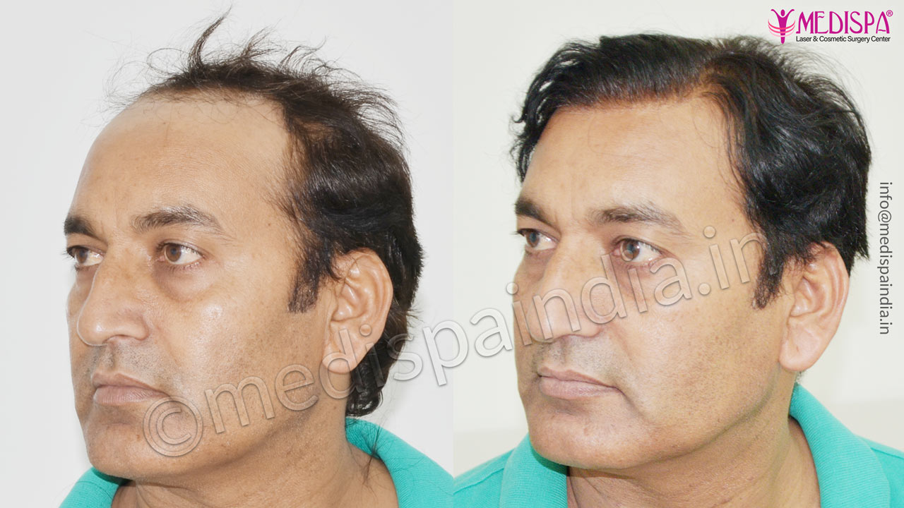 hair transplant surgeons in south delhi