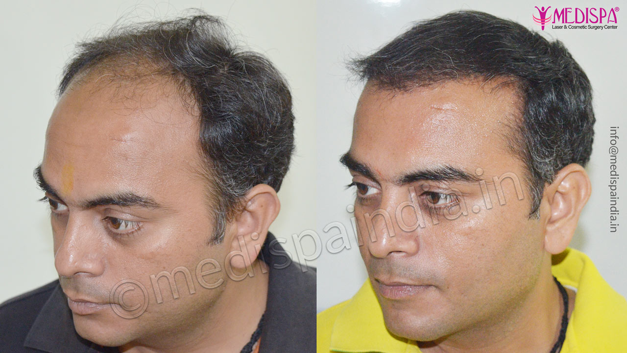 hair transplant surgeons in surat