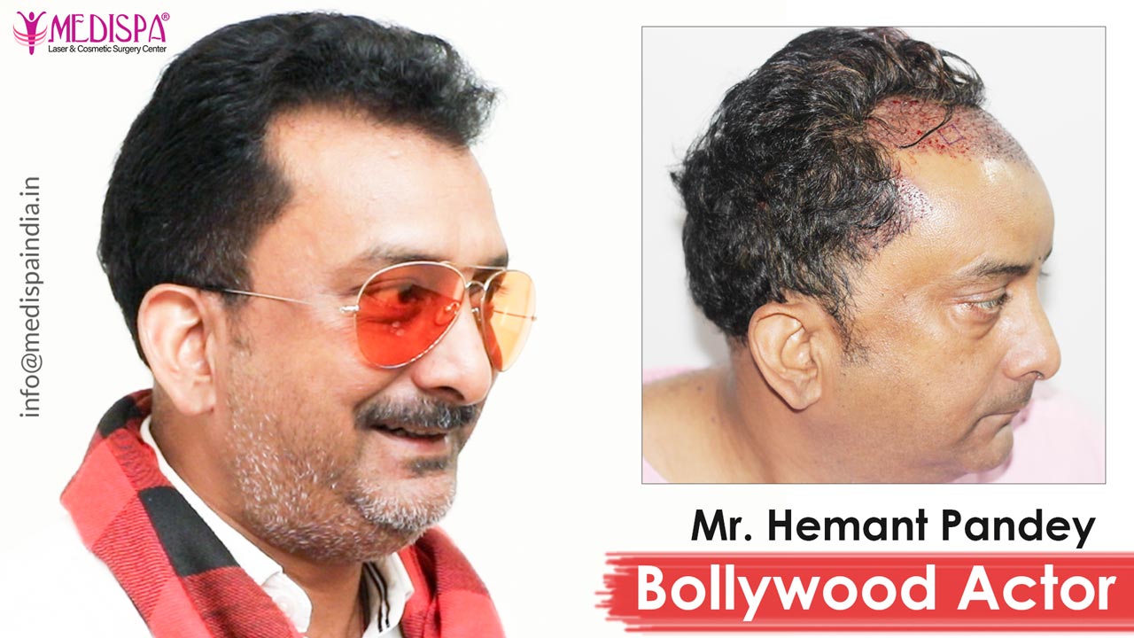 Bollywood Actor – Hemant Pandey Hair Transplant Results