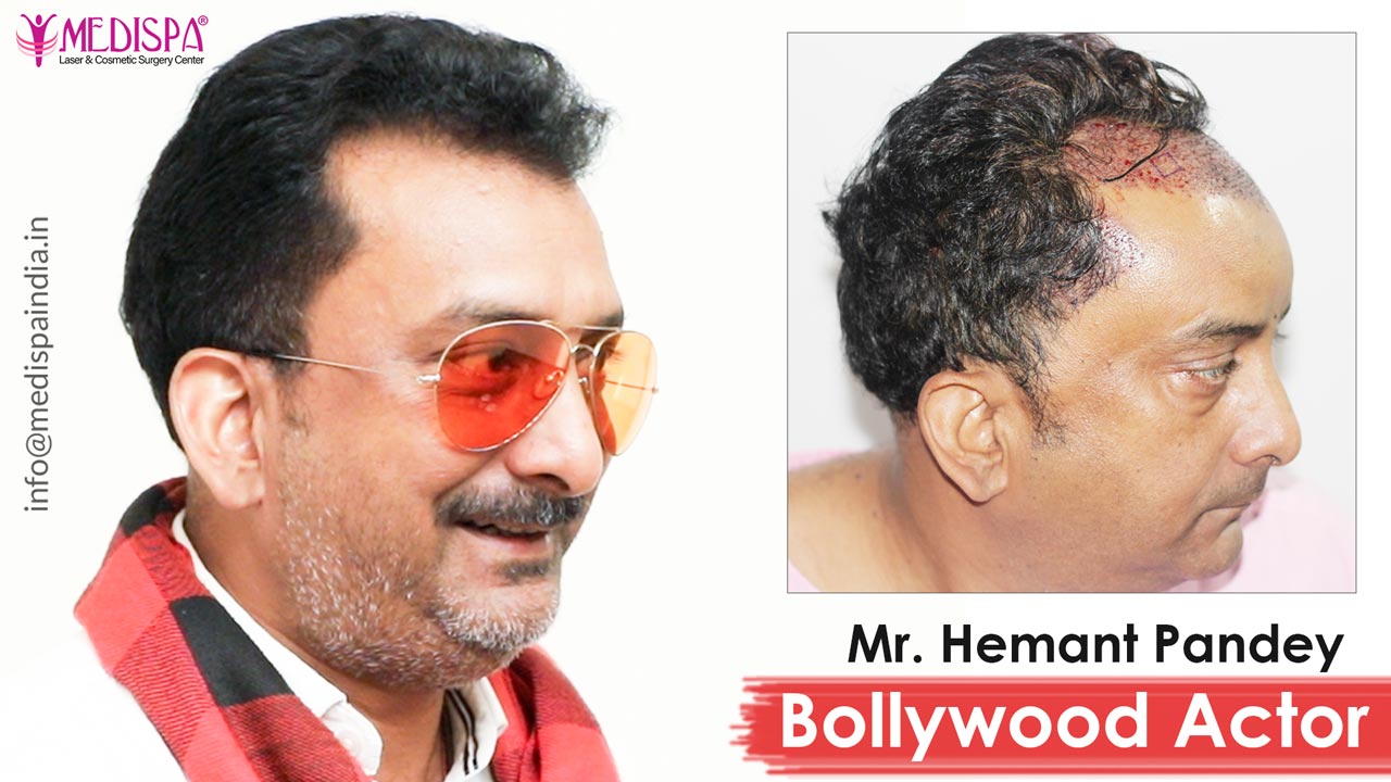 Bollywood Actor – Hemant Pandey Hair Transplant Results Bollywood Actor – Hemant Pandey Hair Transplant Results