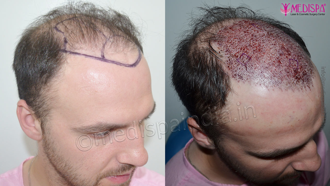 ireland hair transplant results