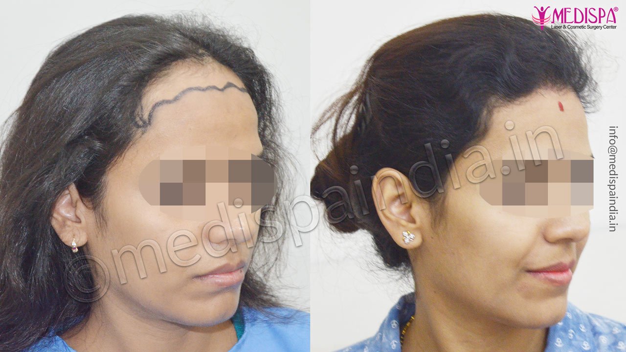 jaipur hair transplant cost india