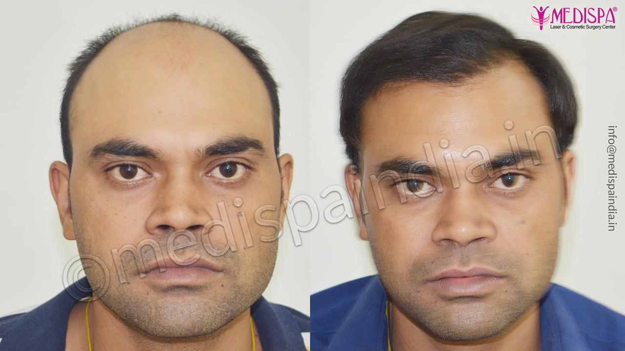 jaipur hair transplant cost