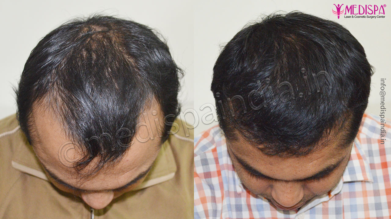 london hair transplant cost