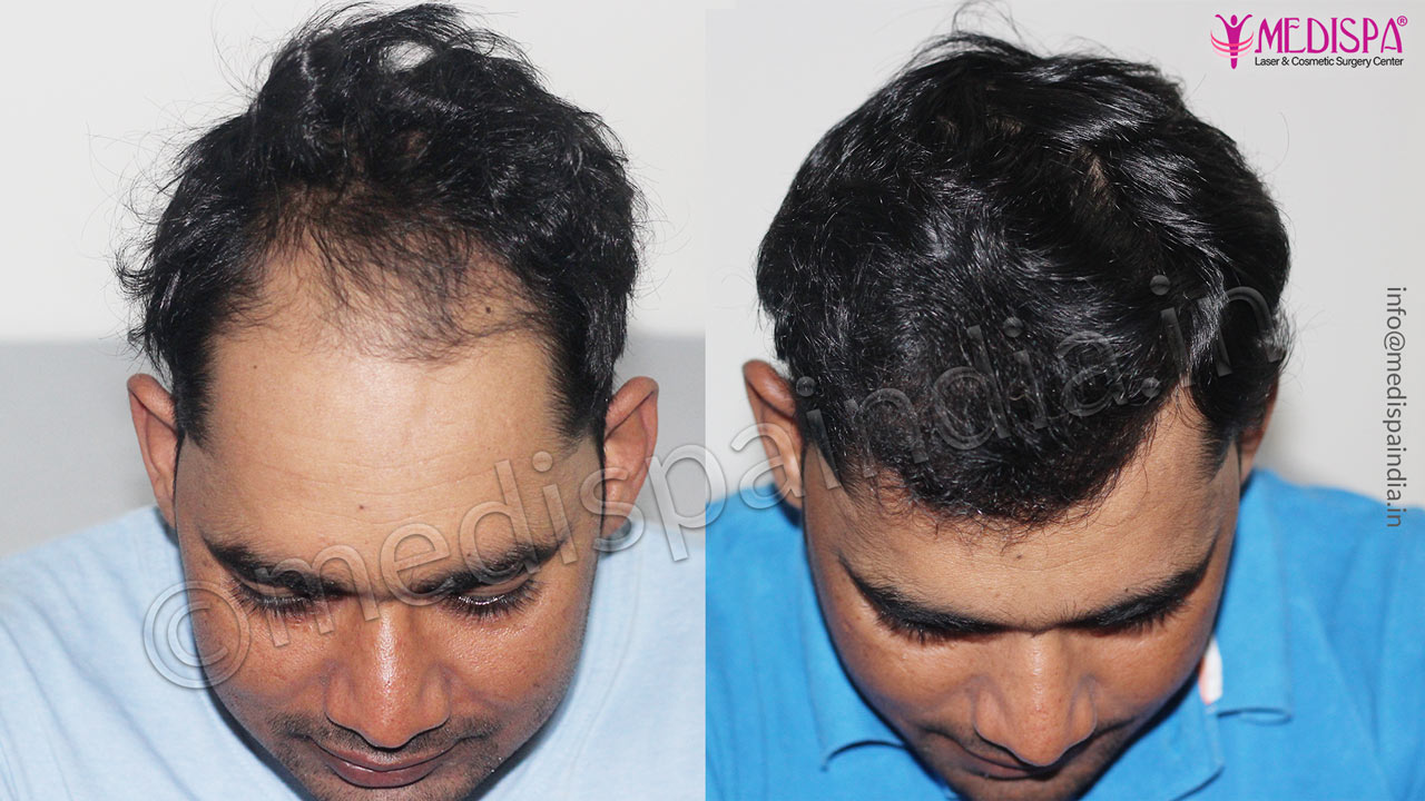 male hair transplant before after-1-year
