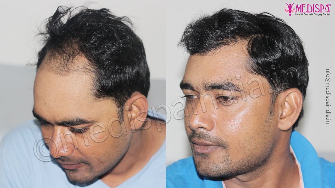 male hair transplant before after results
