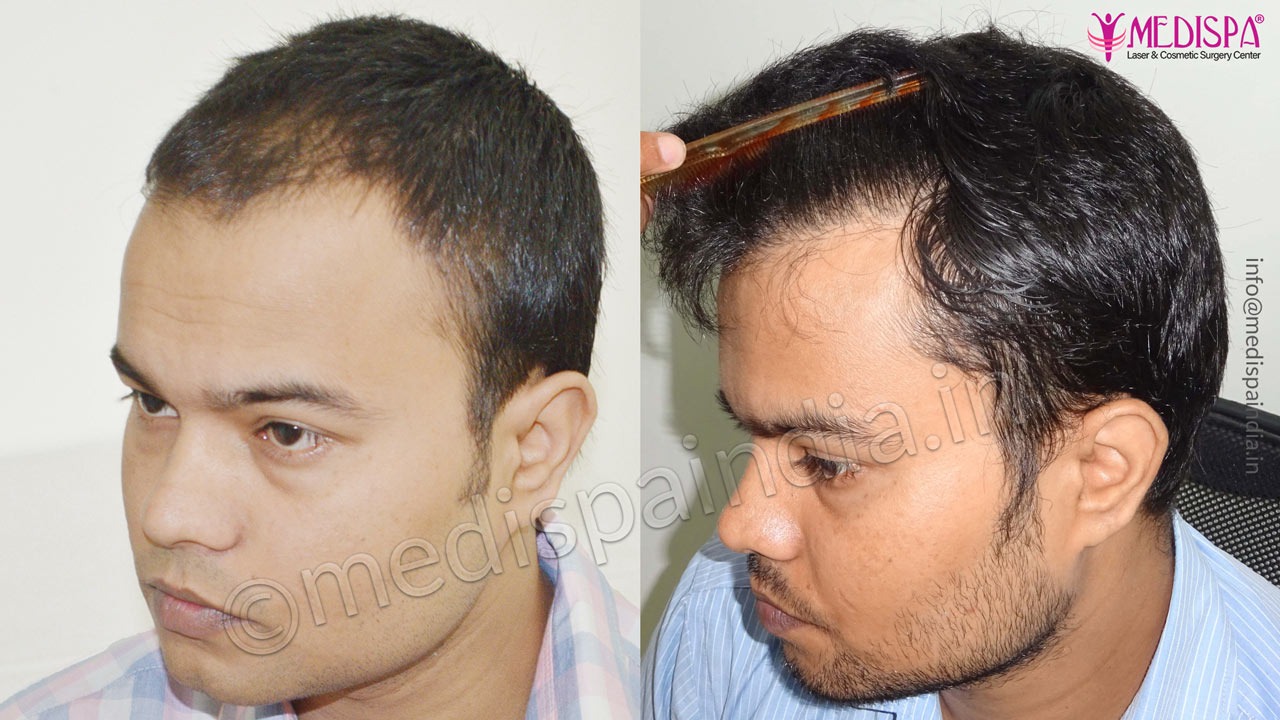 male hair transplant results delhi