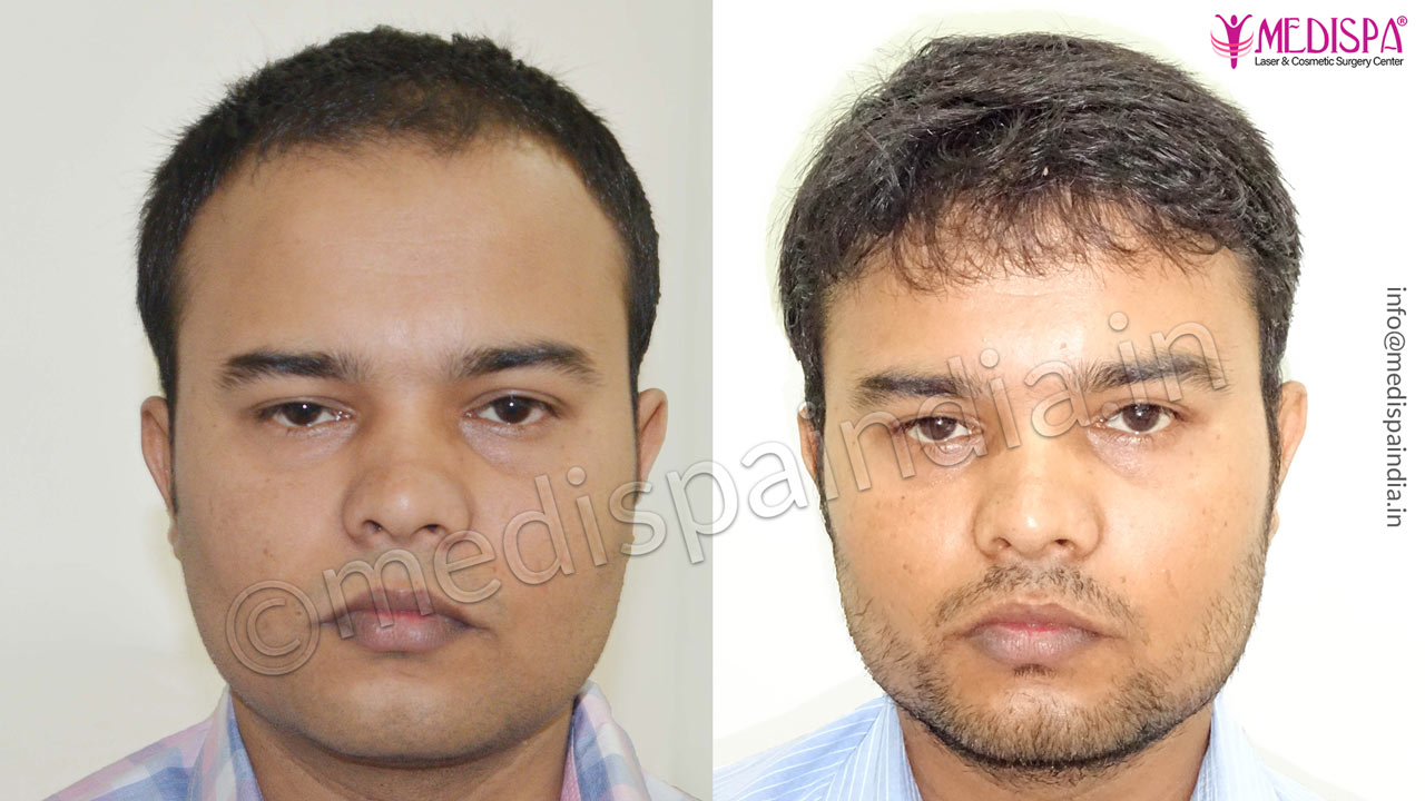 male hair transplant results india