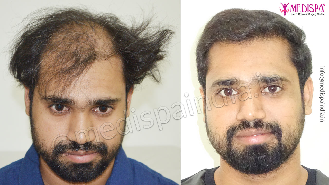 Hair Transplant Results / Before & After | Medispa India Hair Transplant Results / Before & After | Medispa India