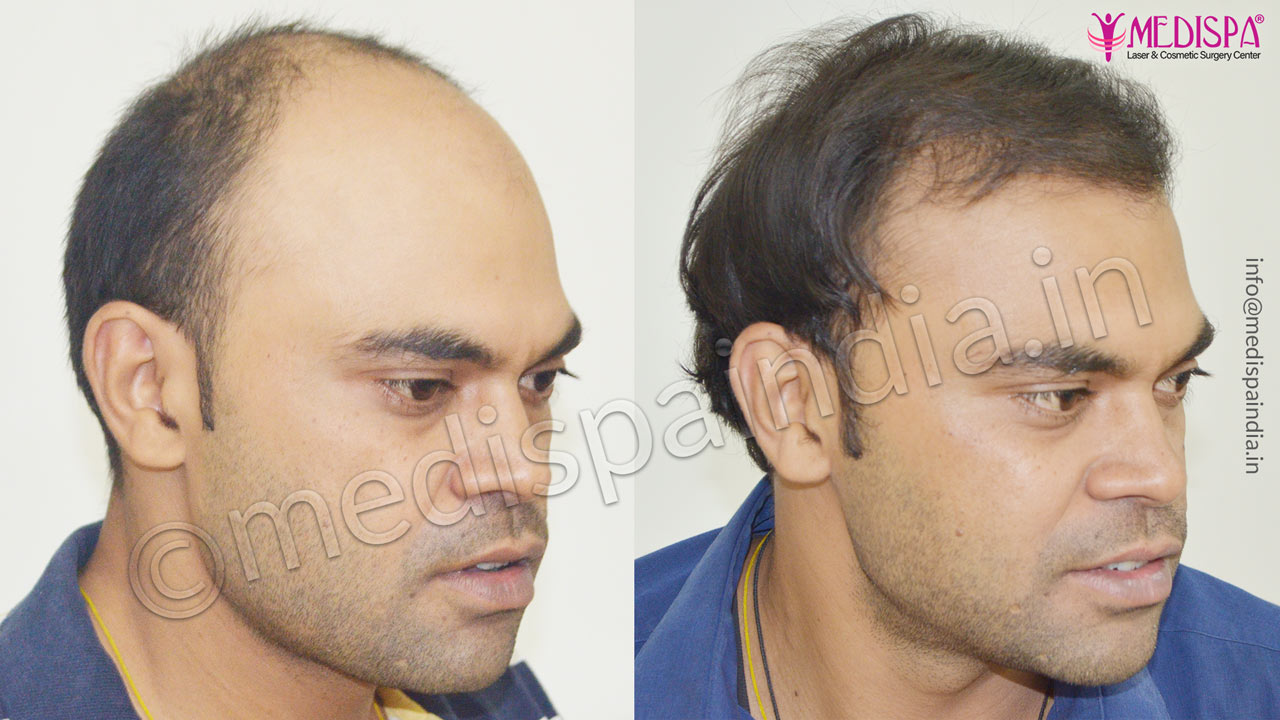 rajashan hair transplant clinic