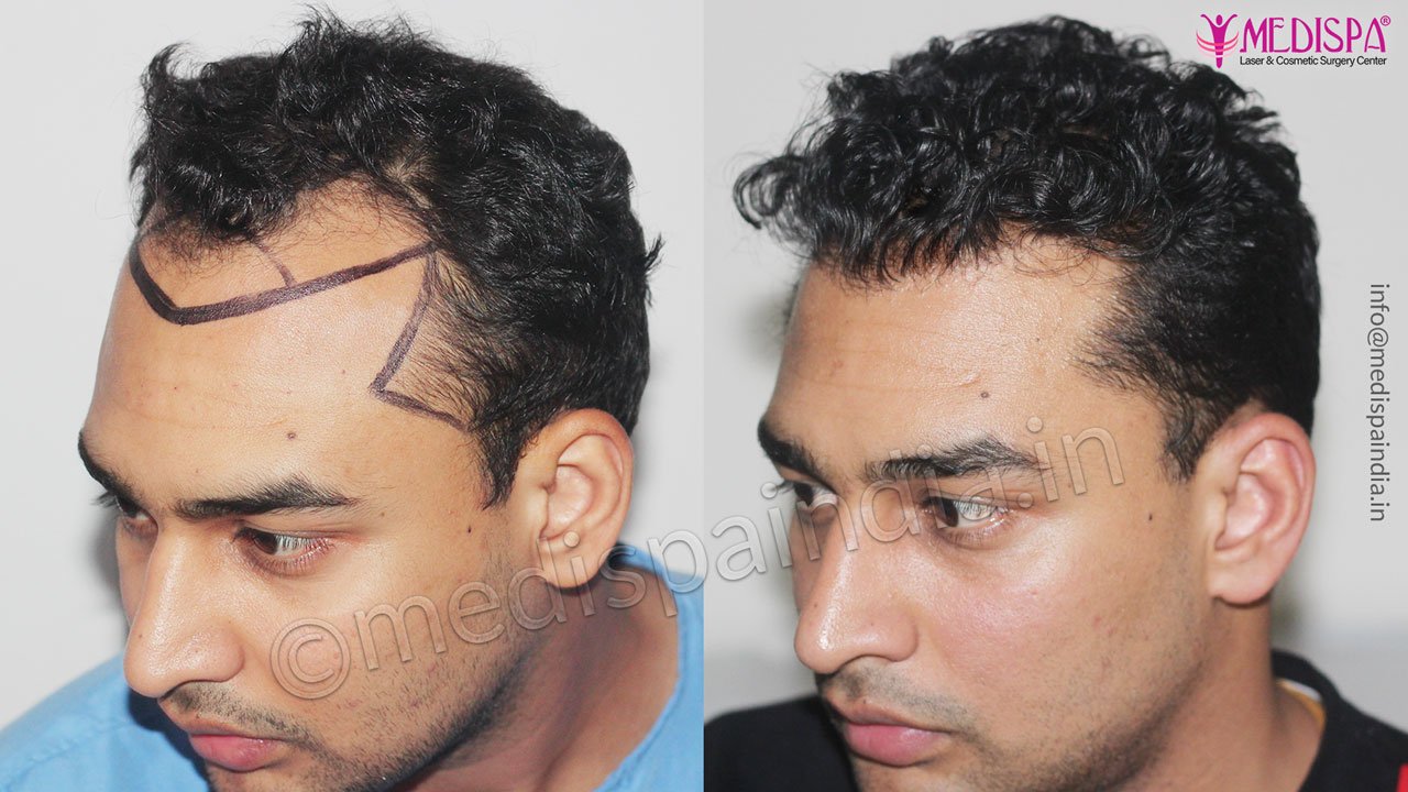 results hair transplant india