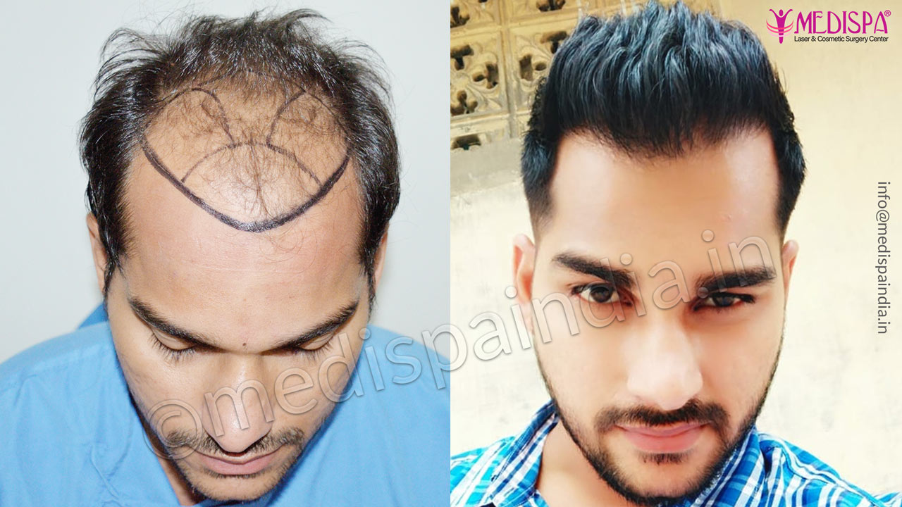 results hair transplant