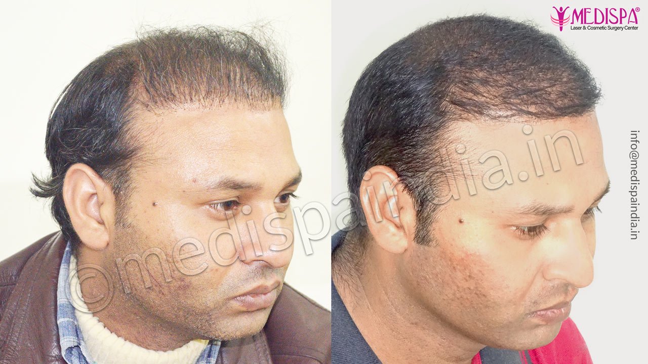 revision hair transplant in india