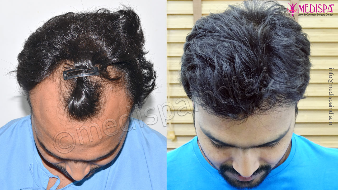 top hair transplant clinics in mumbai