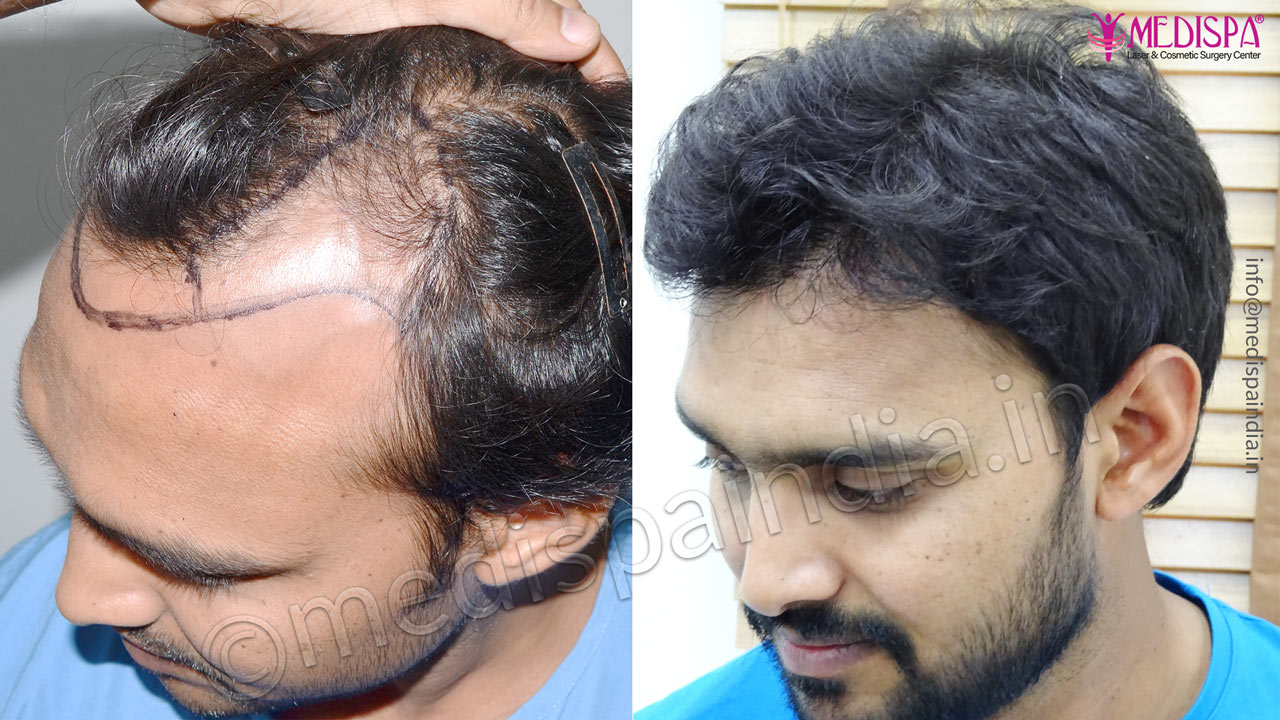 top hair transplant clinics in pune