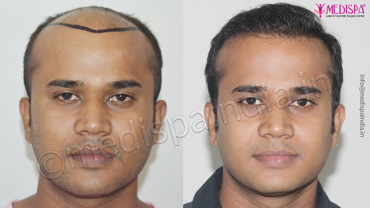 hair transplant cost in dubai